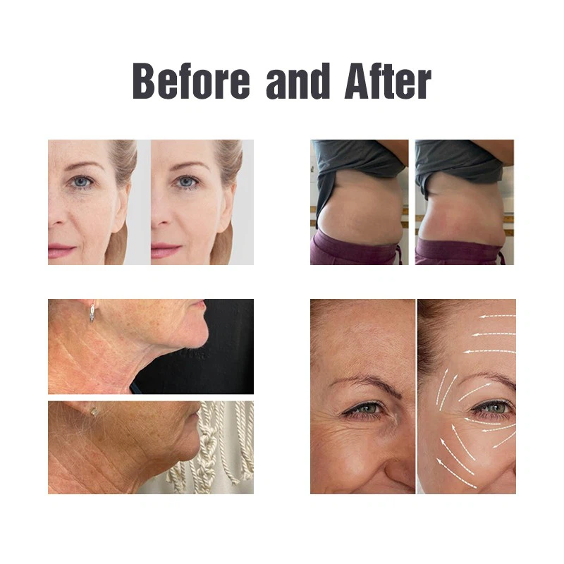 Cryoskin Machine – Professional Non-Invasive Slimming & Skin Rejuvenation Solution high quality