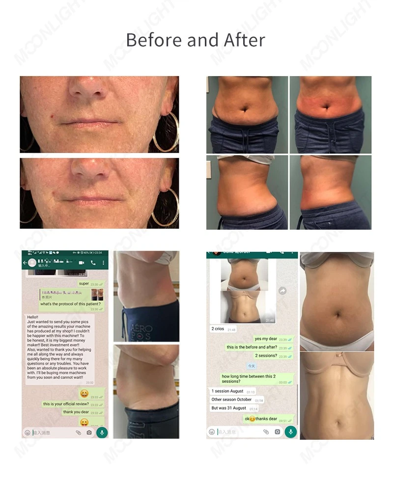 MNLT Cryoskin 4.0 Slimming Machine
