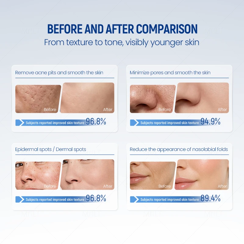 1927nm Thulium Laser System – Advanced Skin Renewal & Precision Treatment suppliers